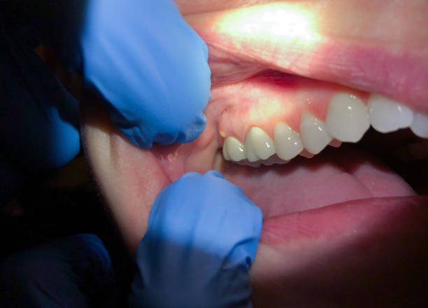 Best Emergency Denture Repair in Bryson City, NC